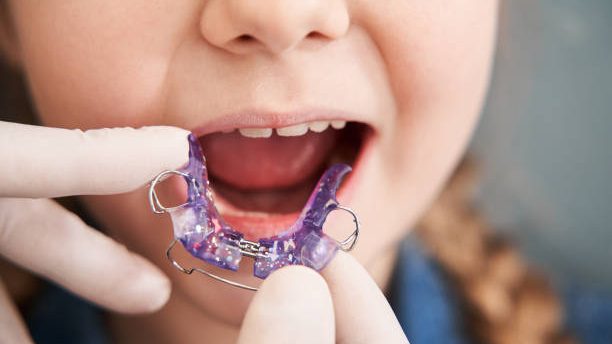 apparecchio-mobile-bambini-palato-e1673454451236